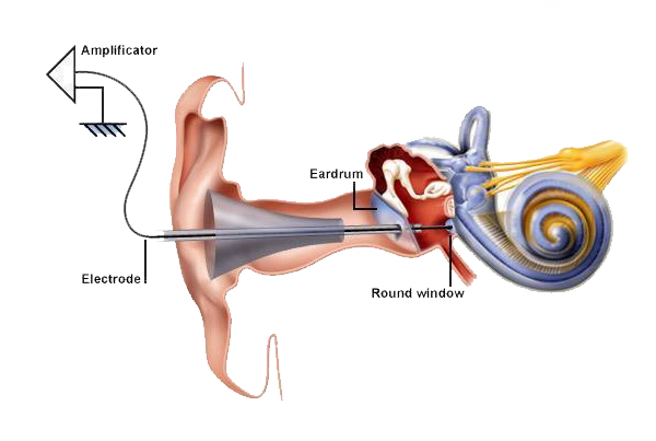 Ecoch G Electrocochleongraphy