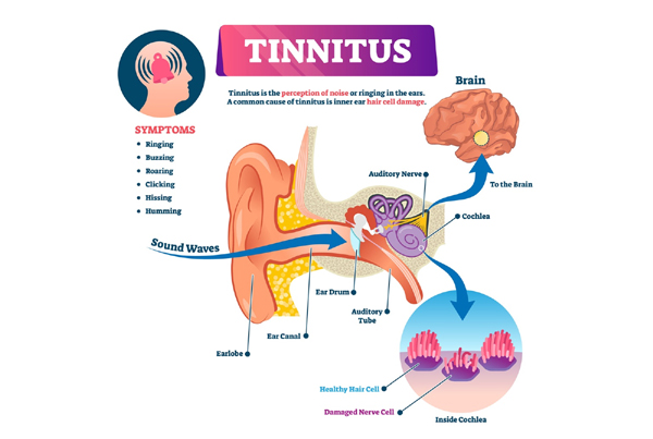 Tinnitus and Its Management