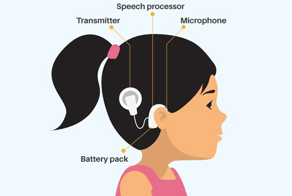 Cochlear Implant